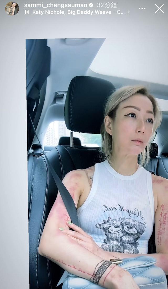 鄭秀文手臂上都是刮痧痕跡。（圖／翻攝自sammi_chengsauman）