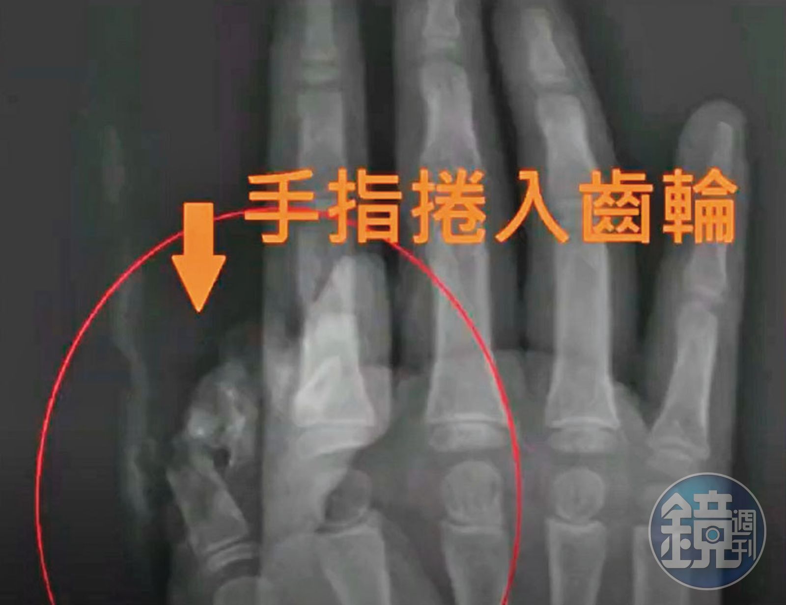 吳小姐的女兒大拇指捲入升降椅齒輪，導致傷殘。（圖／鏡週刊）