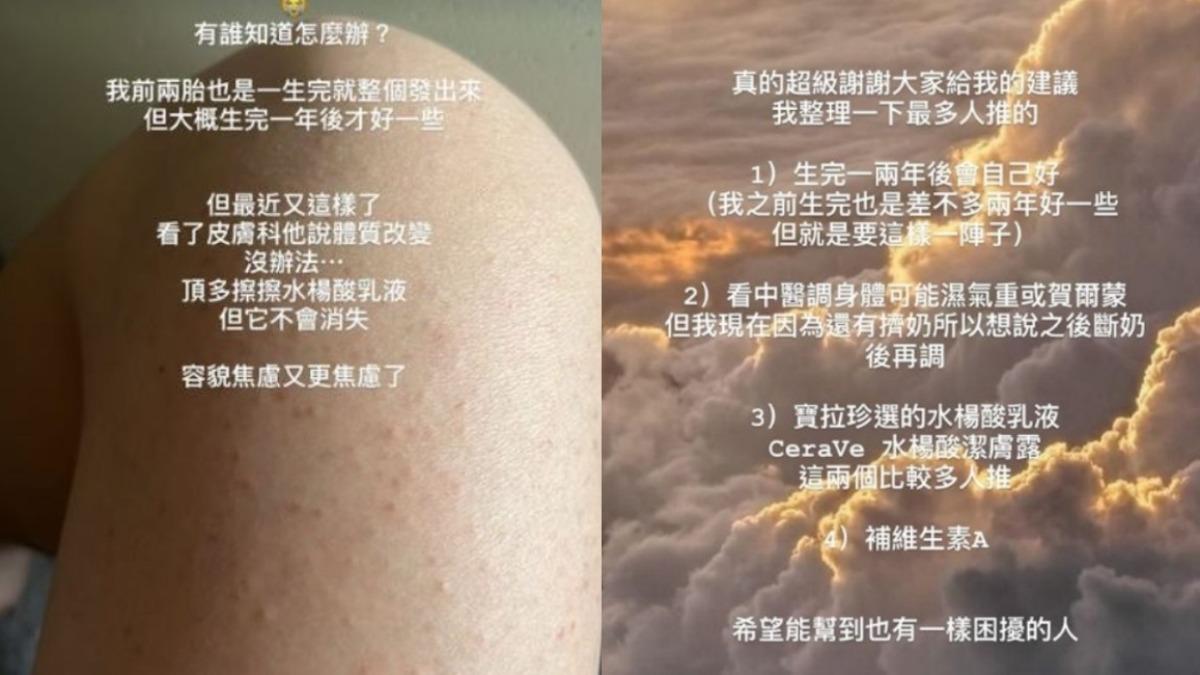 羅文罹毛囊角化症。（圖／翻攝自IG@tiffanywenlo）