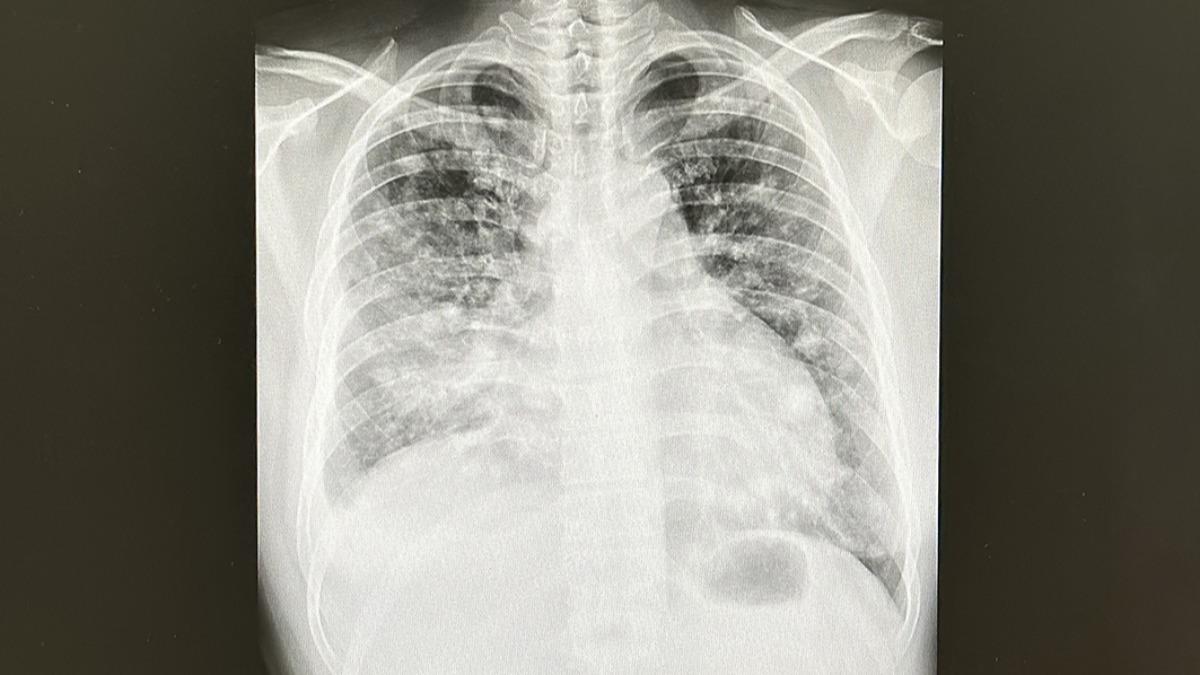 36歲男不菸不酒！咳1個月竟是「肺癌四期」　醫示警5病癥