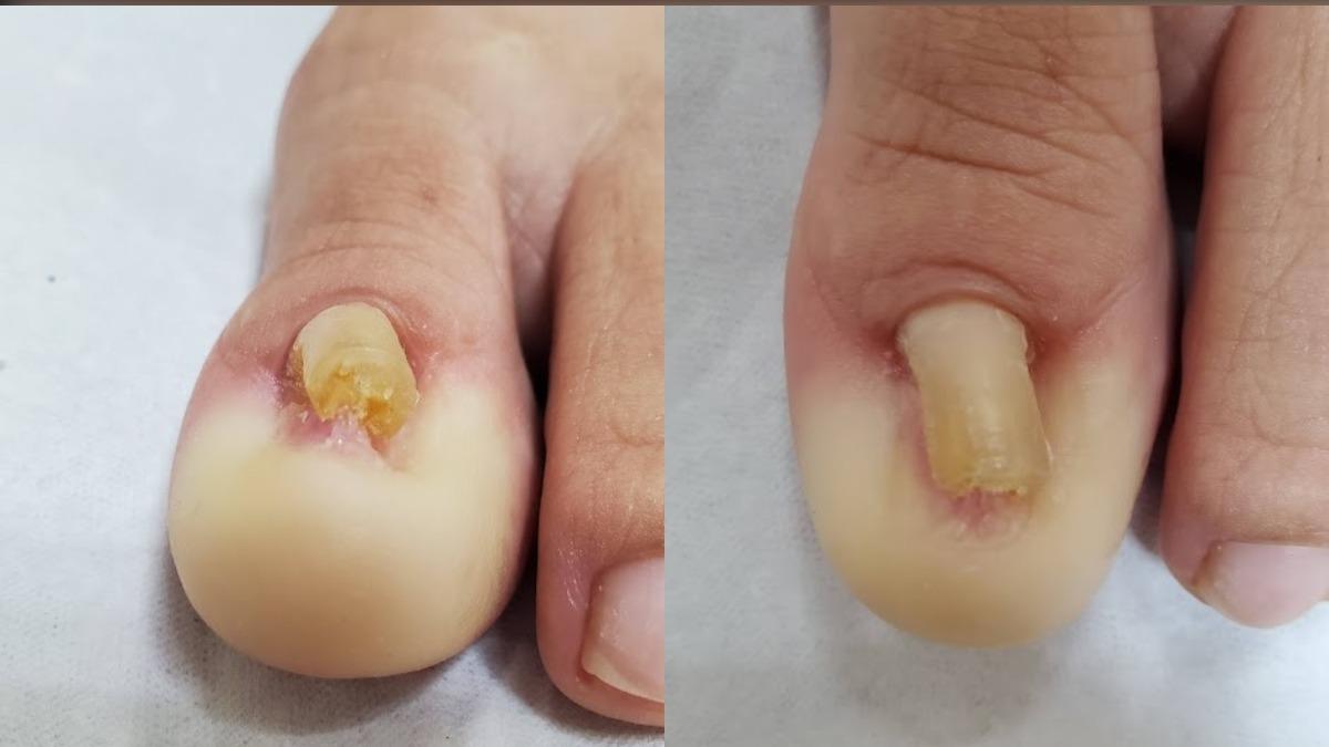 櫃姐腳指甲剪太短!竟捲成「鉛筆甲」痛爆 醫曝最好剪法