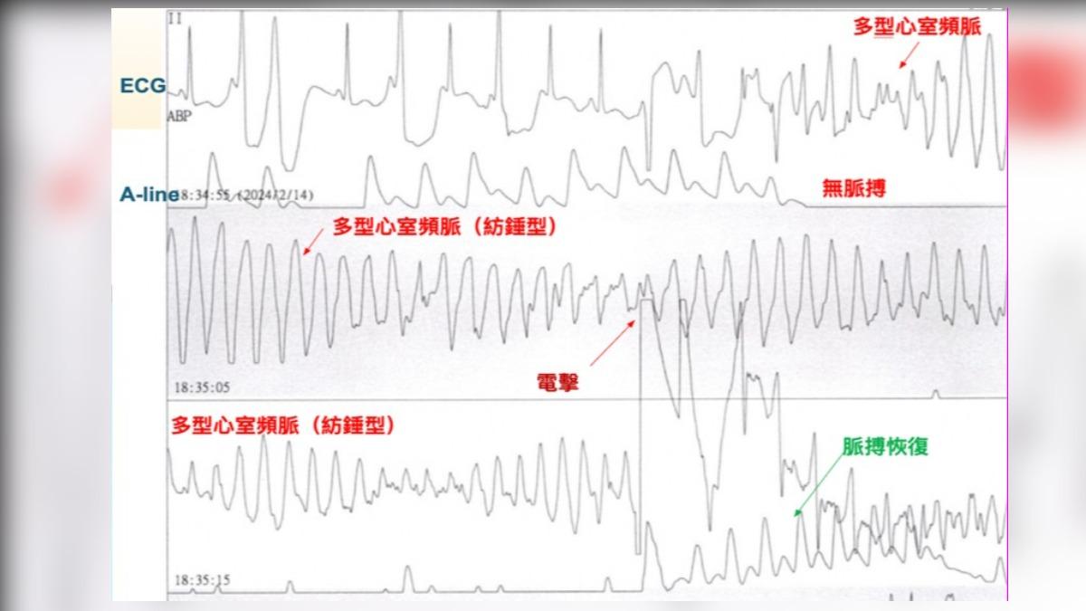 小涵電擊22次搶命,狀況才穩定下來。(圖/中國醫提供)