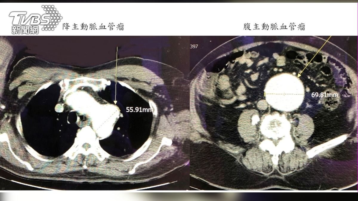 兩顆血管瘤引劇痛 動脈支架手術助恢復