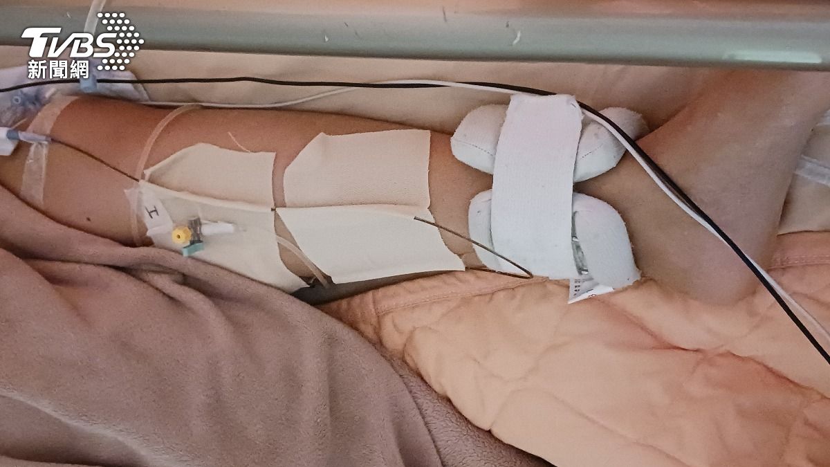 左下肢靜脈栓塞脹痛 蒙古27歲少婦遠赴3000公里外台灣求救