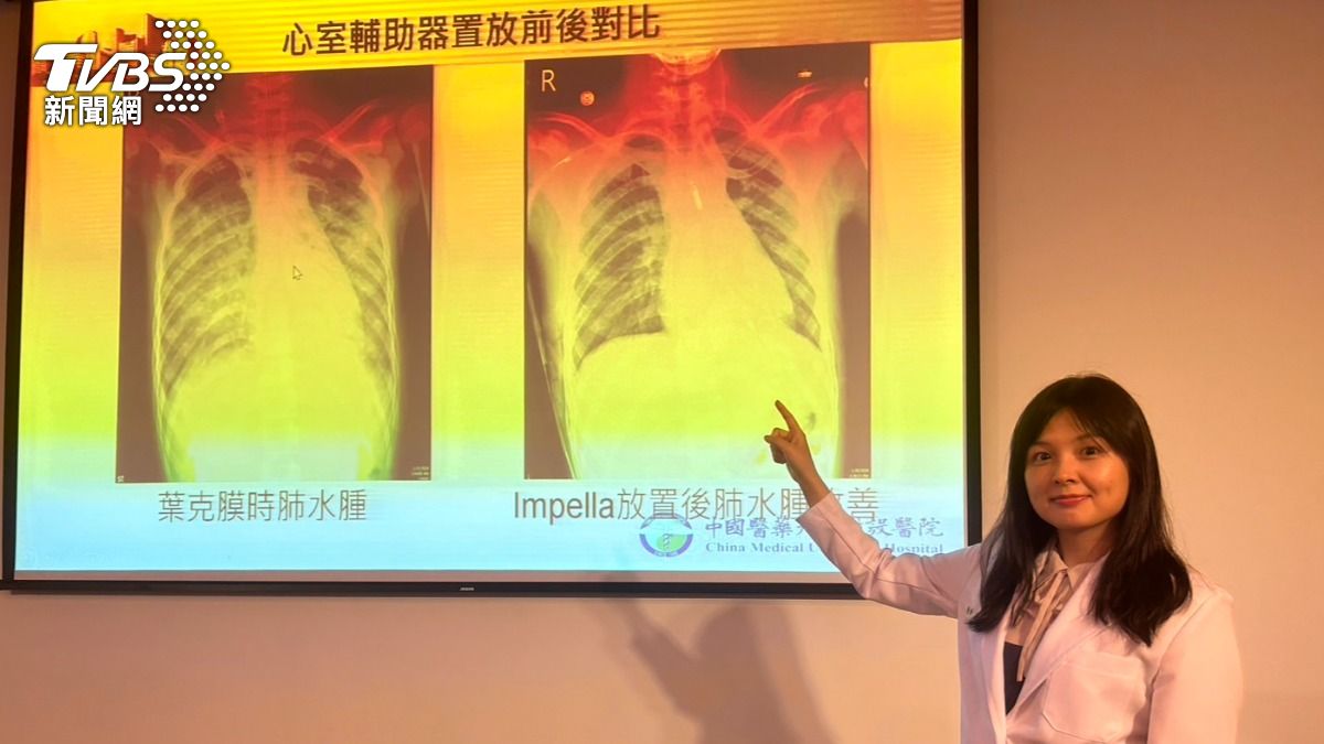 葉克膜雖可替代部分心肺功能進行體外循環,但嚴重併發症很多。(圖/林冠丞攝)