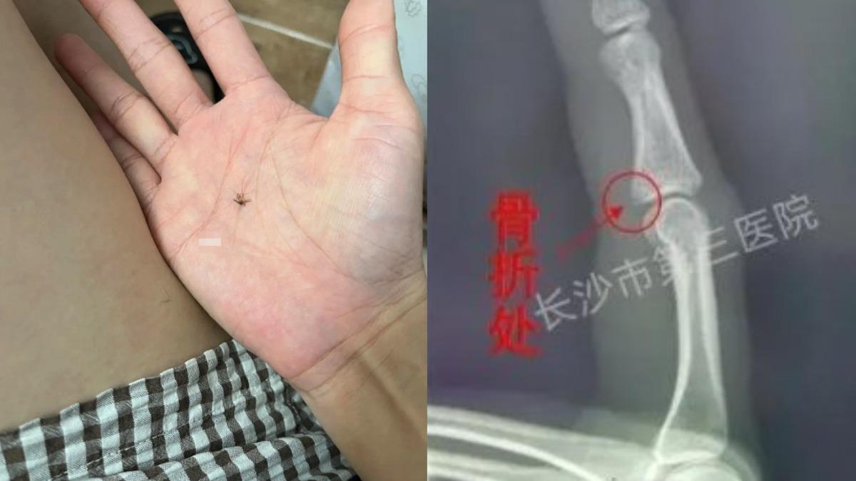 蚊子咬不停！35歲陸女火大猛拍　手超痛驚「打到骨折」