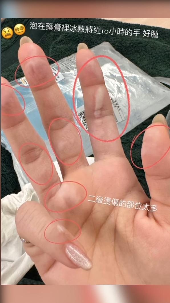 許允樂意外燙傷。(圖/翻攝自許允樂IG)