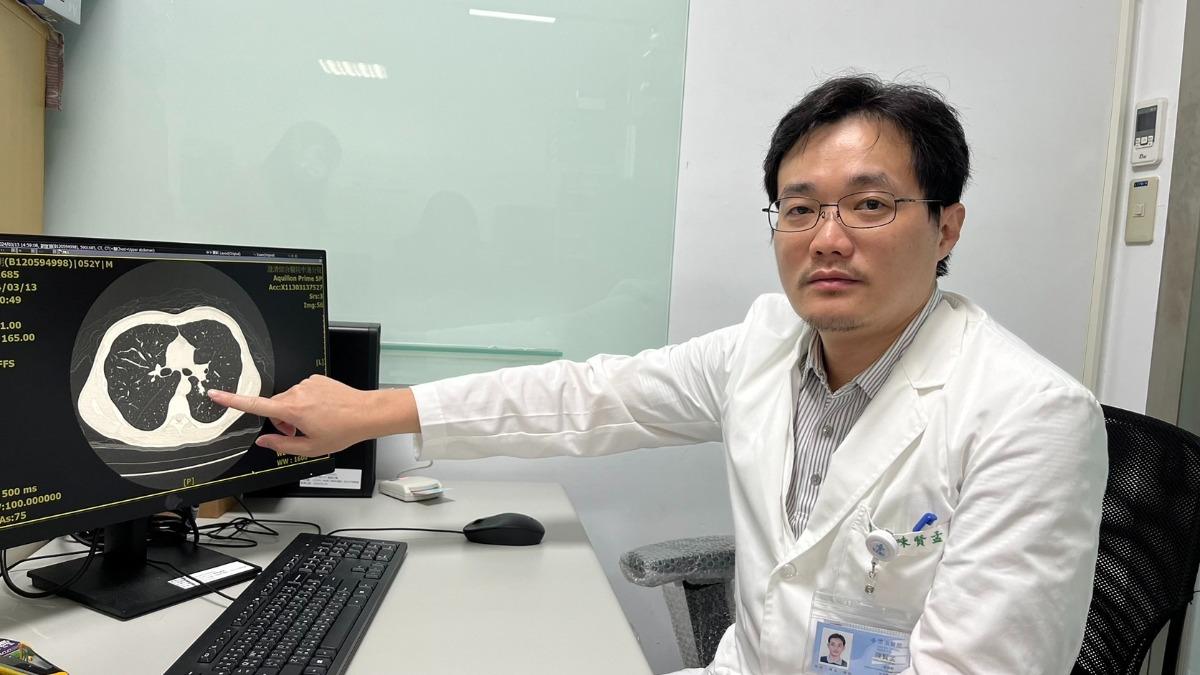 球黴菌常見感染來自美國西南方與地球西半部區域，鮮少出現台灣本土案例。（圖／中港澄清醫院提供）