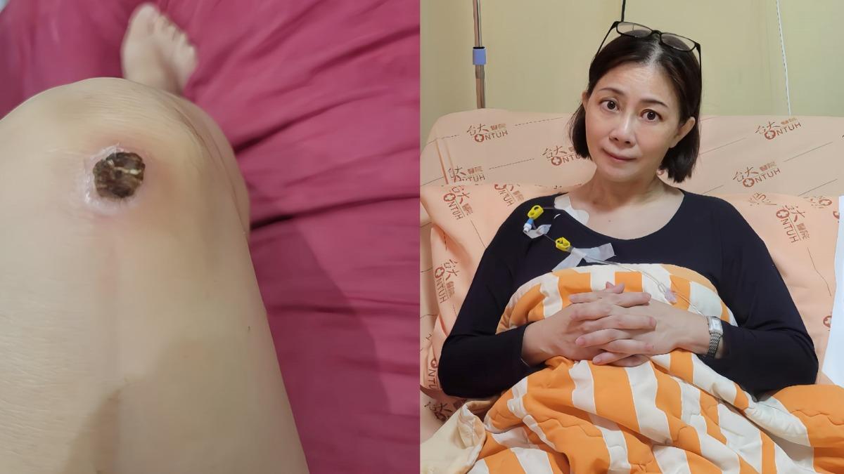 作家小彤罹癌王「突爆喜訊」 4次化療頭髮狂掉:女兒不會成孤兒