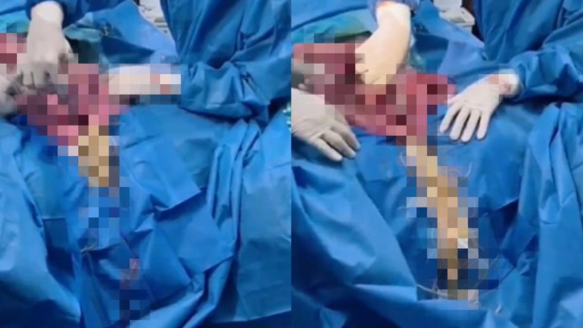 開刀瞬間「蛔蟲瀑布噴出」！美醫護看傻　竄滿手術台畫面曝