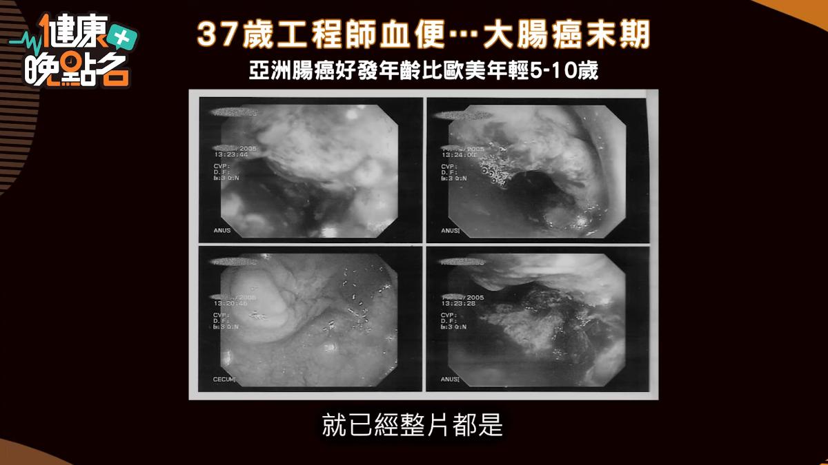 內視鏡一探進肛門，約3/4都是腫瘤。（圖／翻攝自57健康同學會 YouTube）