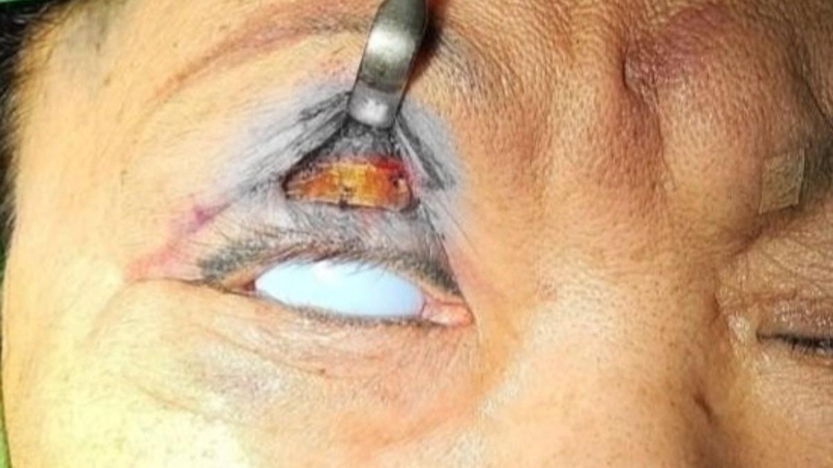 台中婦患乾眼症險失明 眼瞼埋「1.2克黃金」增重護角膜