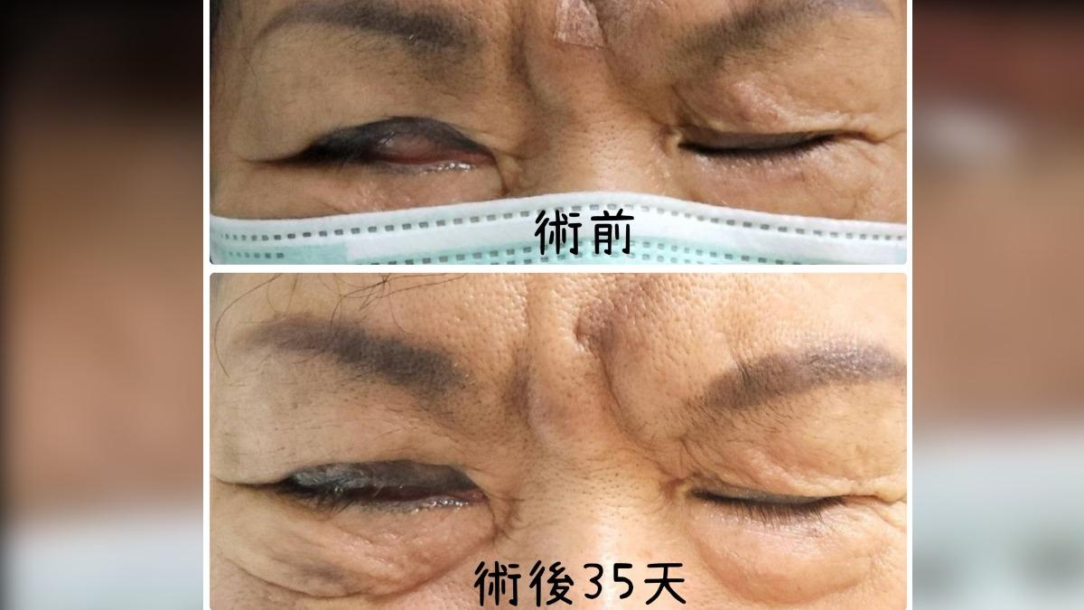 手術相當順利,王婦右眼能完全緊閉。(圖/光田醫院提供)