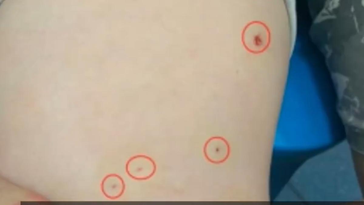 男子腿部遭鐵屑噴入。（圖／翻攝自微博）