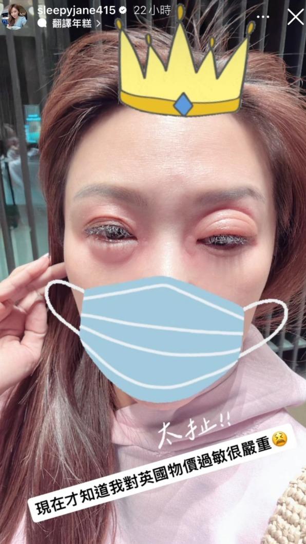 佩甄因過敏眼睛腫起來。(圖/翻攝佩甄臉書)