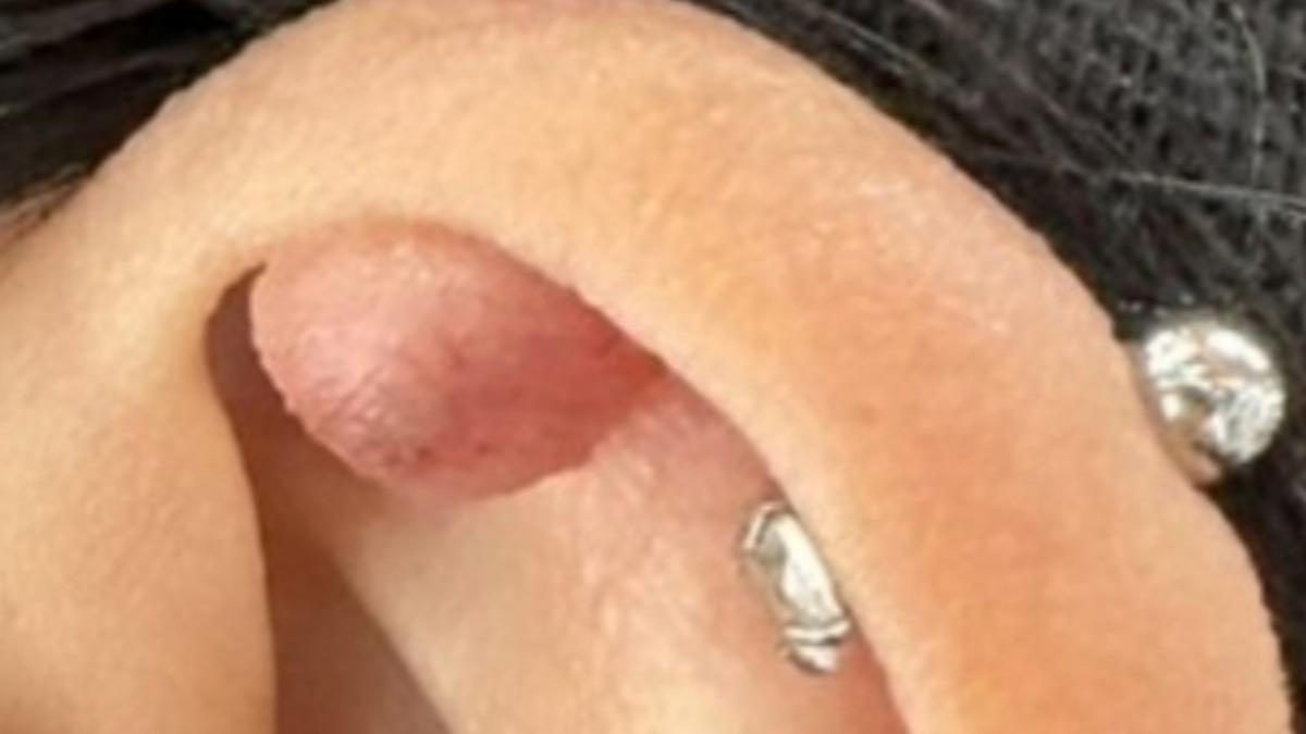 28歲女穿耳洞!1年後耳朵竟冒小肉球 醫揭原因