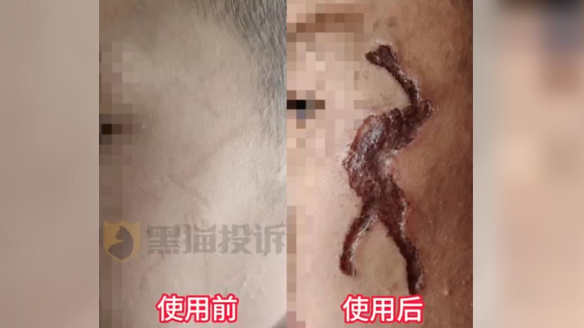 花300元買祛疤膠...陸童一抹「左臉龜裂腐爛」直接毀容