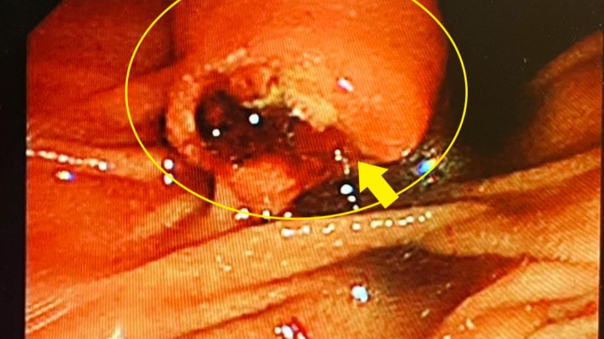 腫瘤位置致壺腹腫大。（圖／澄清醫院中港分院提供）