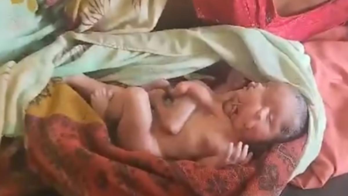 印度罕見畸形嬰兒！天生「2臉4手4腳」　誕生不到半天驟逝