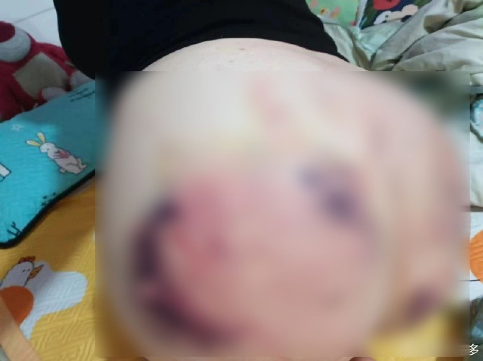 正妹的臀部,滿是傷痕。(圖/翻攝自微博)