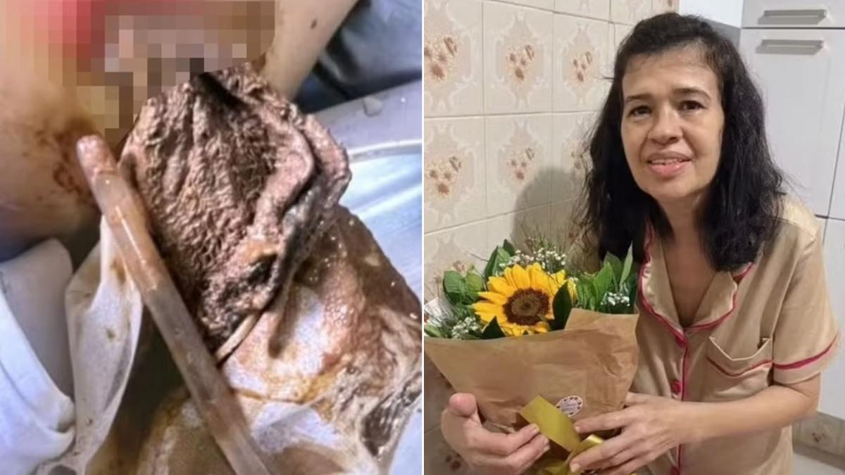 巴西婦胃痛以為癌症復發　動刀驚見「20公分布料」藏體內2年