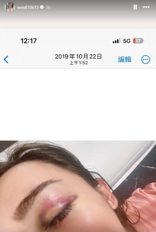 罔腰的眼睛瘀青。(圖/翻攝自IG @wen810615)