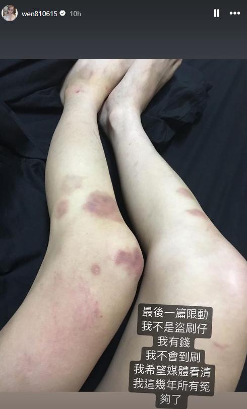 罔腰遭暴力毆打,腳上都是傷。(圖/翻攝自IG @wen810615)