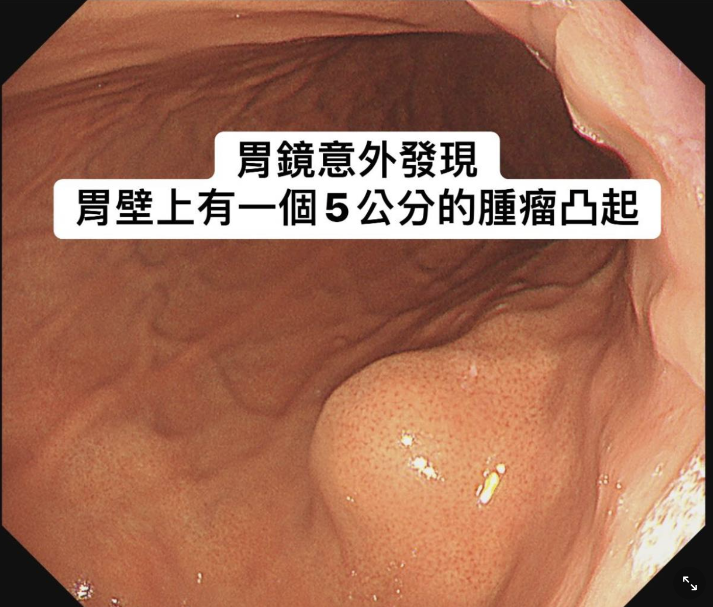 一名30歲的女性沒有慢性病或明顯不適,在檢查時竟發現胃壁上有一個來自胰臟尾部的5公分腫瘤。(圖/翻攝胰臟醫師林相宏禾馨民權內科診所臉書)