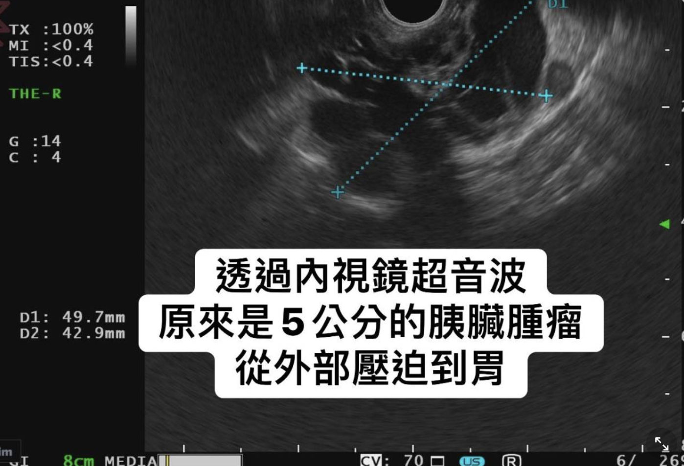 一名30歲的女性檢查時竟發現胃壁上有一個來自胰臟尾部的5公分腫瘤。(圖/翻攝胰臟醫師林相宏禾馨民權內科診所臉書)