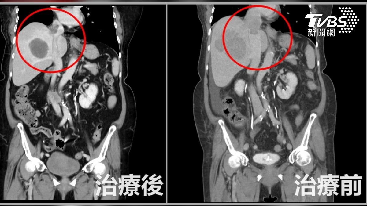 經採用三合一治療後,成功縮小腫瘤。(圖/TVBS)