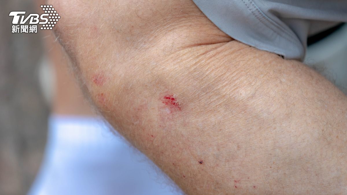 下海游泳「感染食肉菌」!小擦傷秒變黑 英觀光客敗血症亡