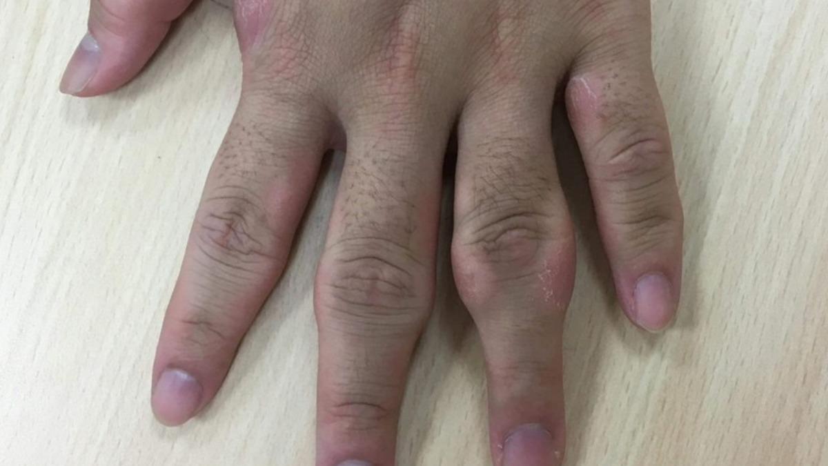 男大生愛折手指！關節突腫脹變形　罹患1少見疾病全球僅百例