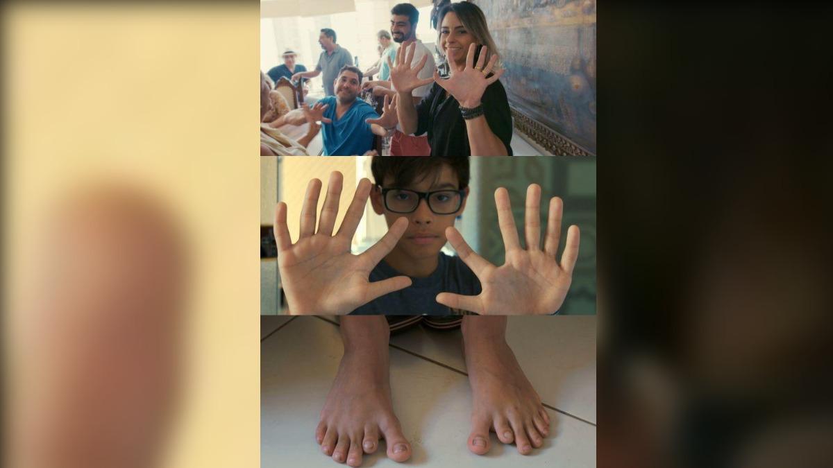 6手指腳趾!巴西一家14口罕病當外掛 彈鋼琴、打球超好用