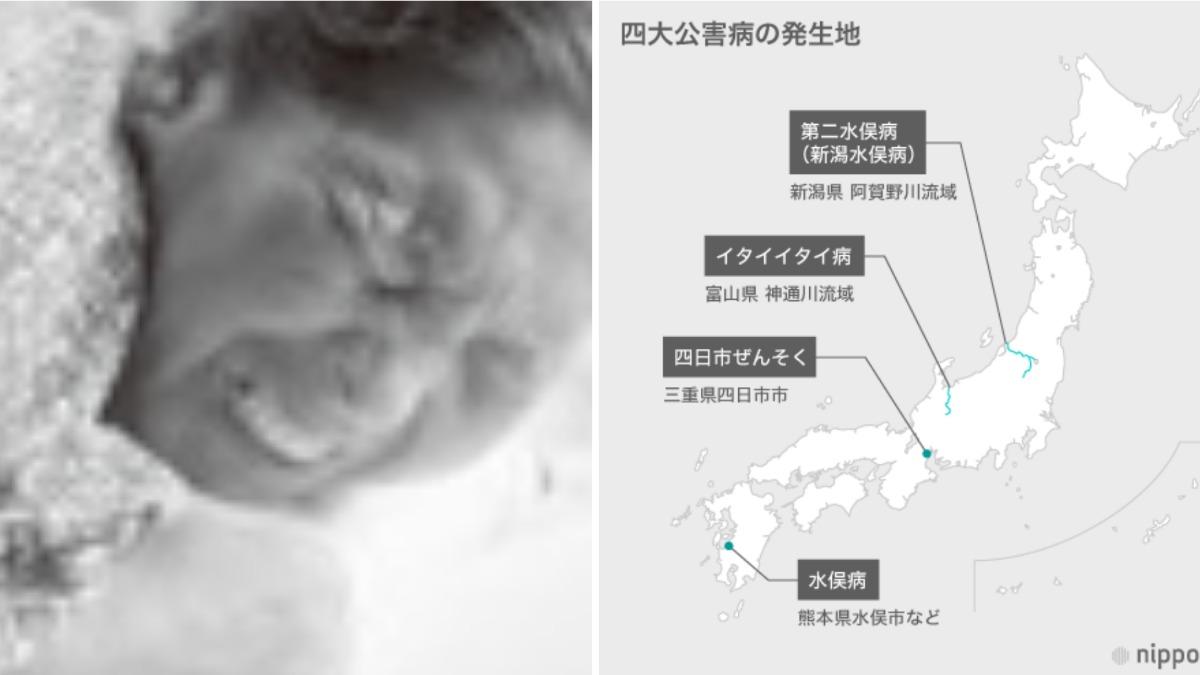 終於歸零！日本4大污染病之一　「痛痛病」93歲患者去世