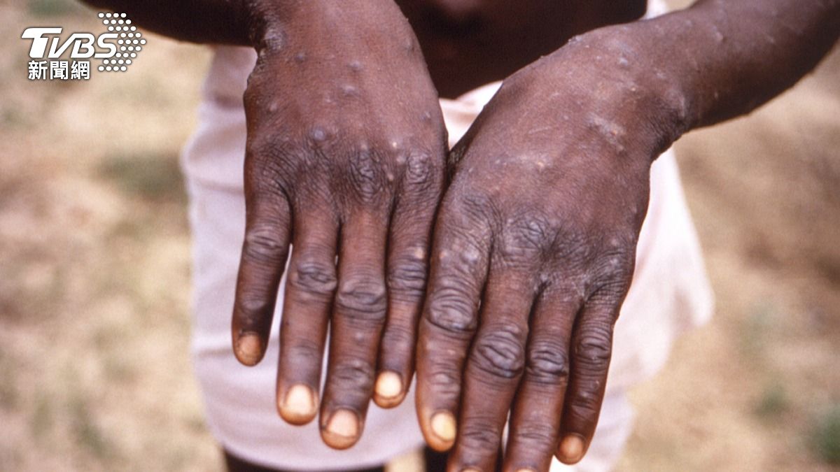 瑞典驚現較危險「M痘病毒株」案例 非洲以外首見