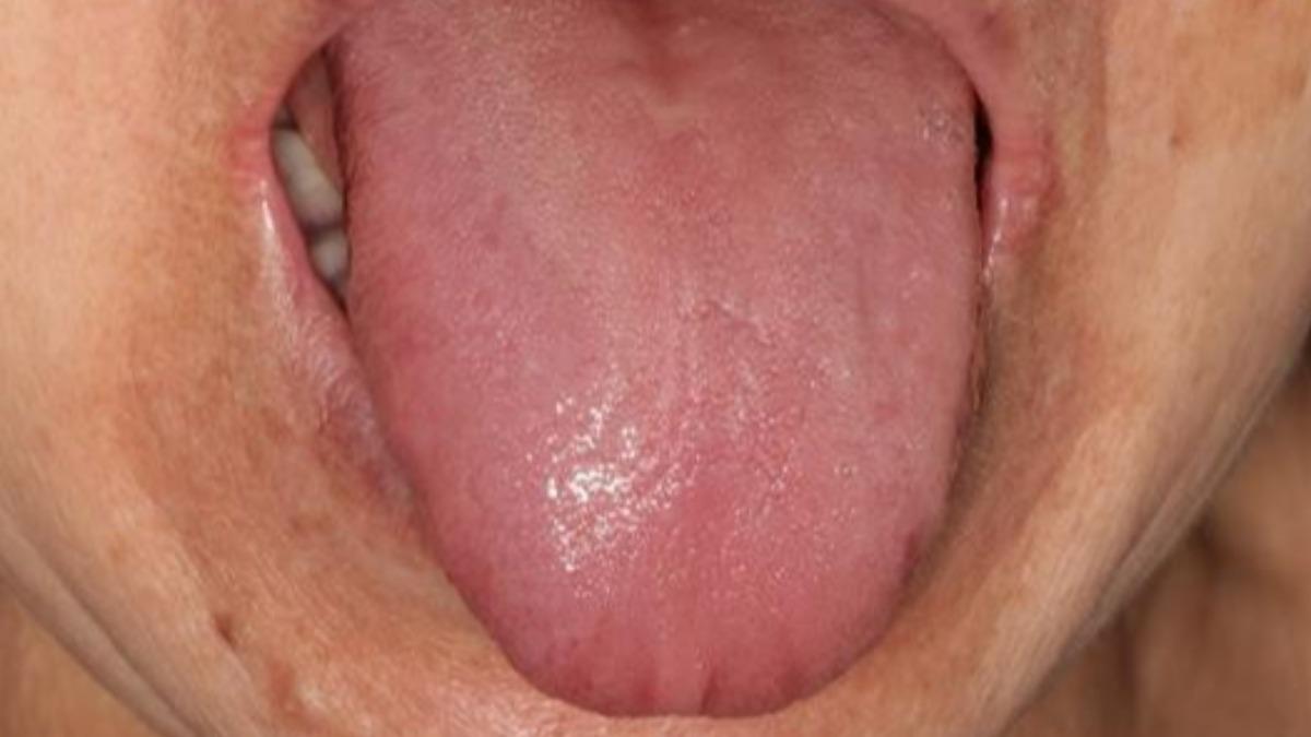 口乾舌燥恐釀念珠菌感染!醫:刺激飲料少喝、口香糖有幫助