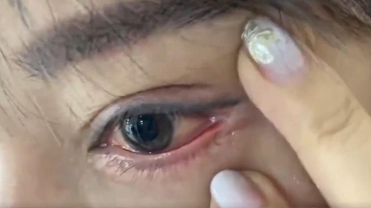 張女每天都得靠眼藥水度日。(圖/翻攝自 微博)