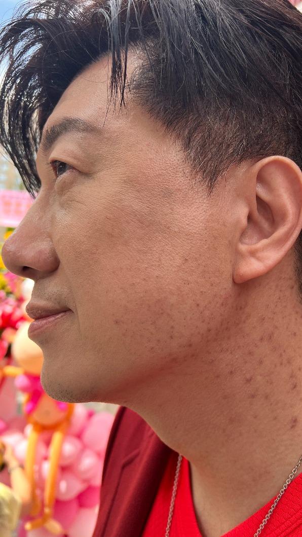 吳皓昇沾到女兒圓禿藥品導致毛囊發炎。(圖/民視提供)