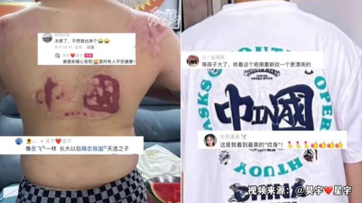 男童慘遭氣爆燒傷…背部血痕烙印「中國」　小粉紅嗨喊：精忠報國