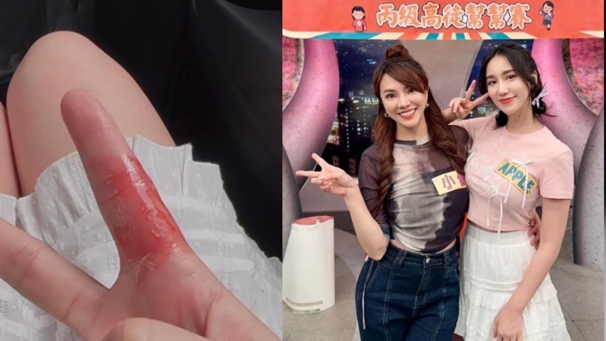《黑澀會》女星錄《型男》爆燙傷意外！　食指「一大片紅腫」傷勢曝光