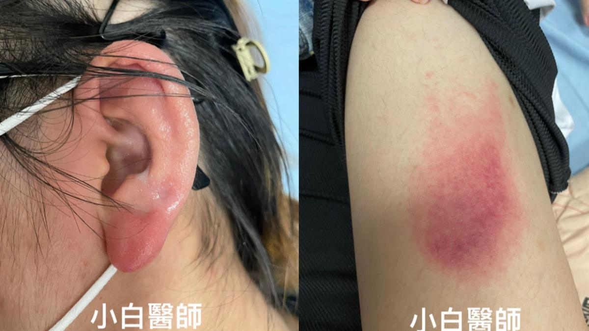 16歲妹打耳洞紅腫流膿!疹子一片「蔓延至腿」 再晚全擴散慘了