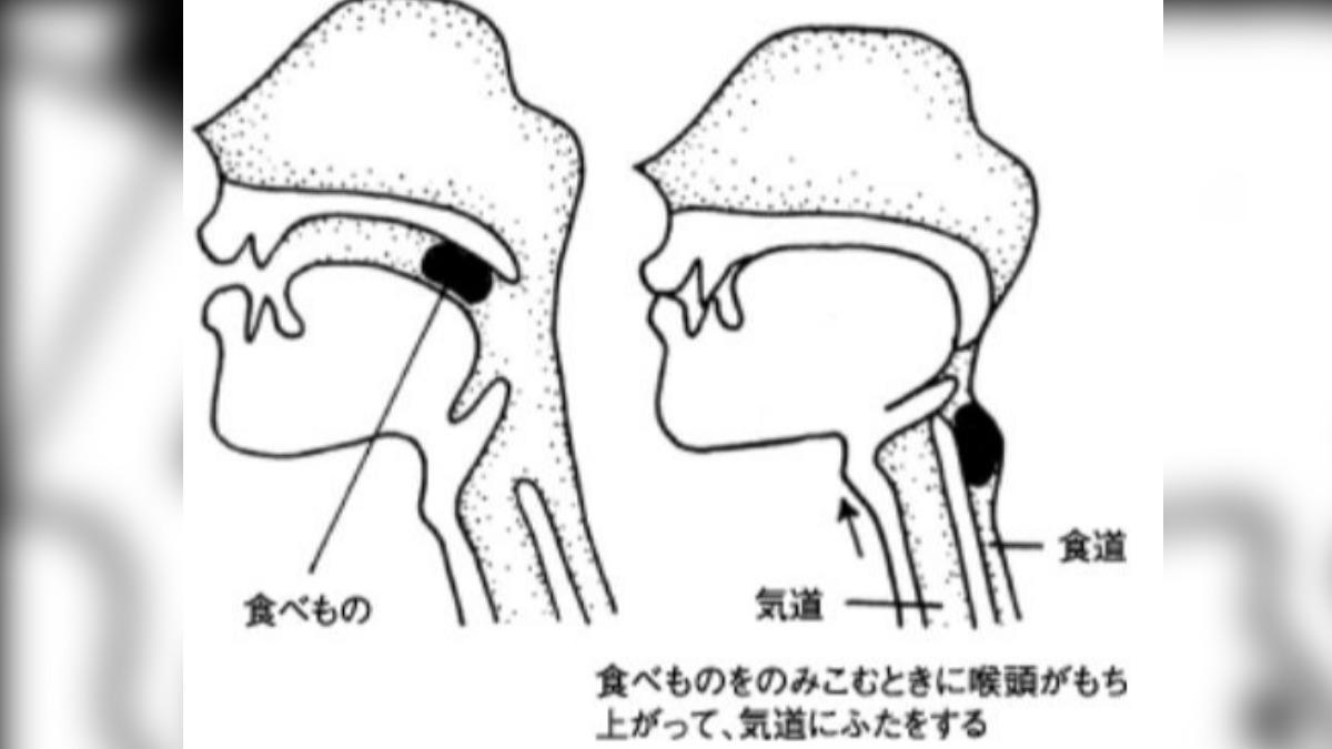 手術醫生誤將氣管插成食道。（圖／擷取自dentalpark.net）
