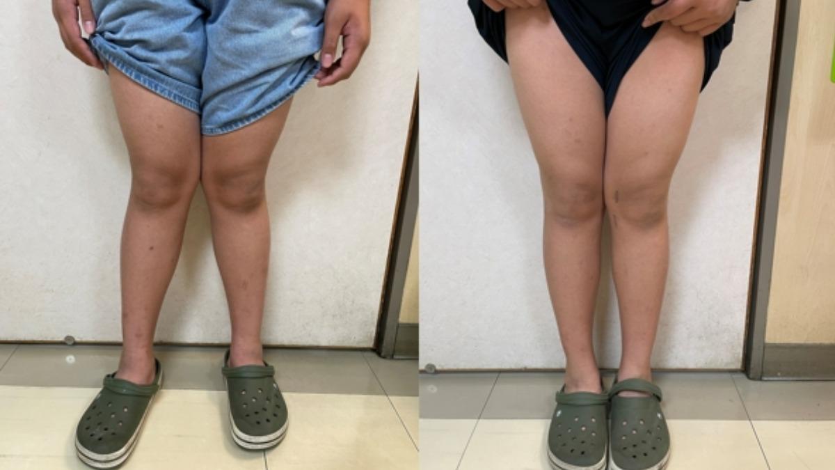 少年腿型呈X狀!運動雙腳膝蓋互撞 醫曝X型、O型腿隱憂