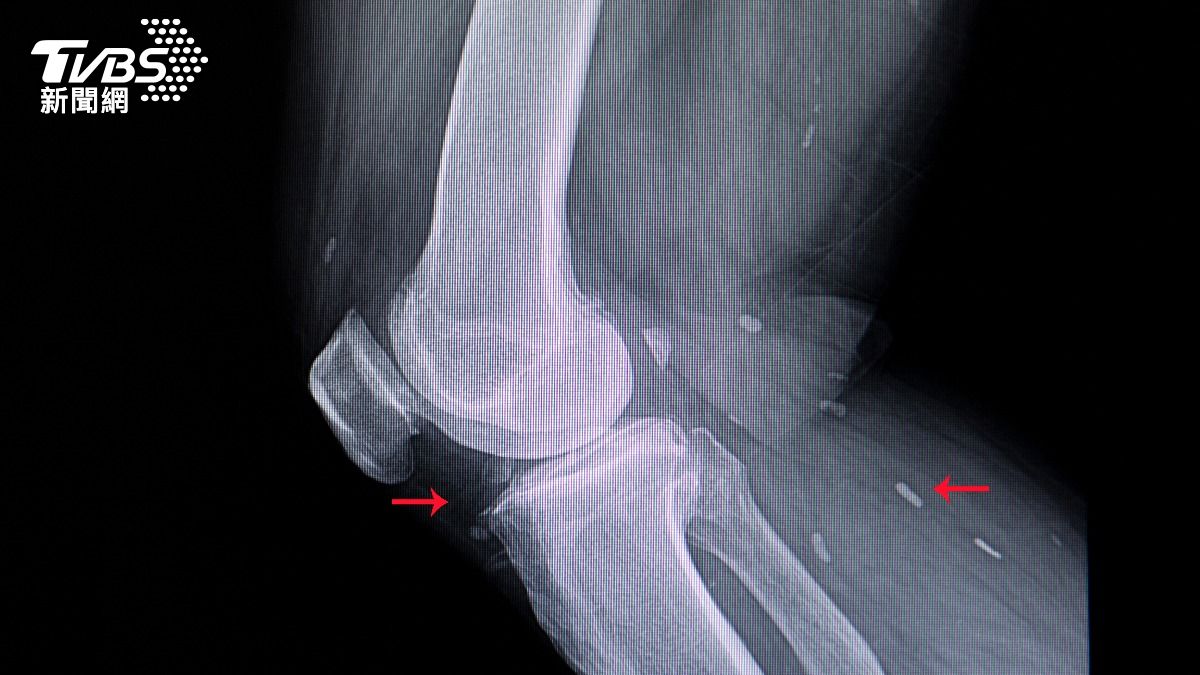 絛蟲的幼蟲可能進入肌肉甚至大腦等組織。(示意圖／達志影像Shutterstock)