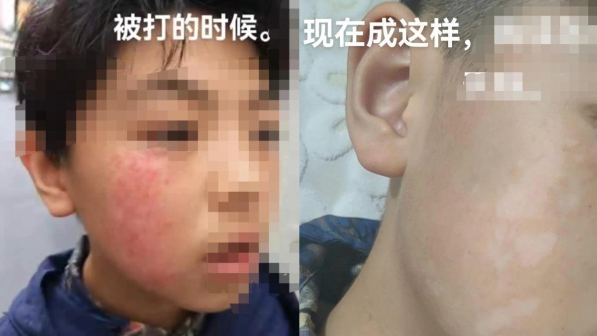 沒寫作業惹怒老師!11歲陸童慘挨4巴掌 「半邊臉爬滿白斑」毀容了