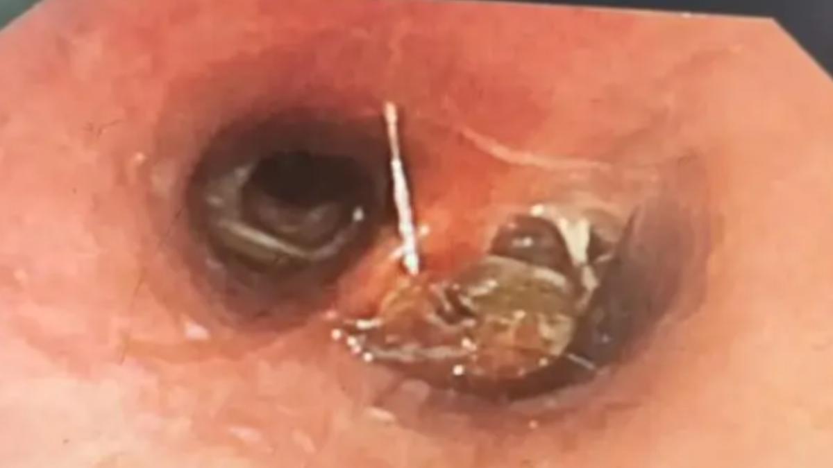 58歲陸男狂咳、口臭!醫師檢查嚇傻:支氣管「夾出一隻蟑螂」