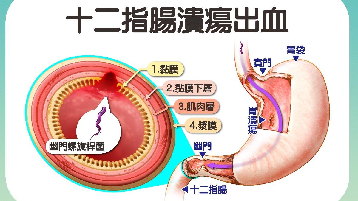 王男因十二指腸潰瘍出血,痛到無法睡覺。(圖/台中慈濟醫院提供)