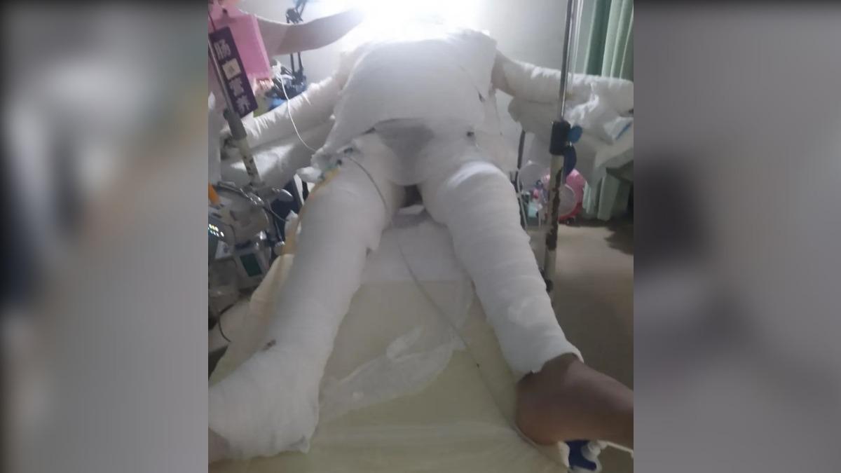武漢男大生充鋰電池爆炸起火！獨自逃生還關門　害室友90%燒傷