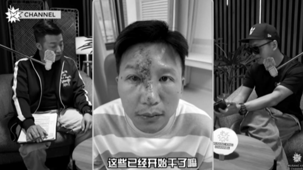 皮蛇蔓延右眼！大馬YTR「Jym」驚曝病情險釀失明危機