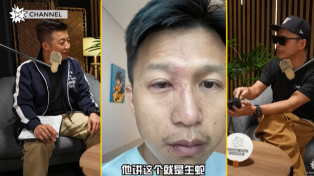 Jym的皮疹長在靠近眼睛的位置,嚴重可能會導致失明。(圖/翻攝自 YT @MusangKingChannel)